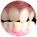 Crooked Teeth Treatment BTM layout 1st Stage